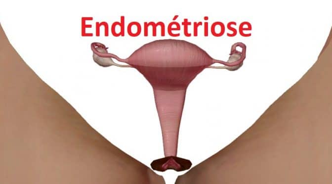 Une solution pour agir naturellement contre l’endométriose