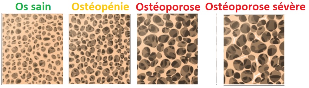 La Chimie_Naturelle du Corps Humain - ostéopénie et ostéoporose - états de os