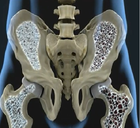 La Chimie_Naturelle du Corps Humain - ostéopénie et ostéoporose - os du bassin