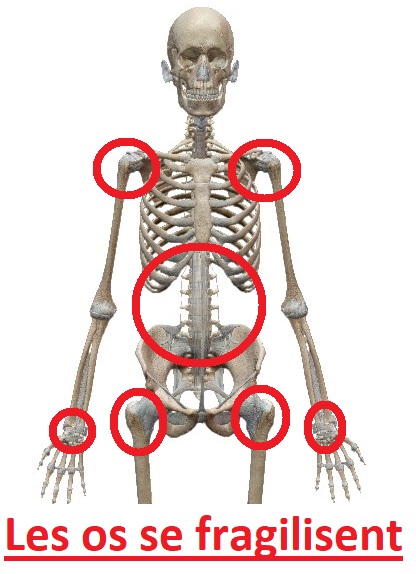 La Chimie_Naturelle du Corps Humain - ostéopénie et ostéoporose - les os se fragilisent = fractures